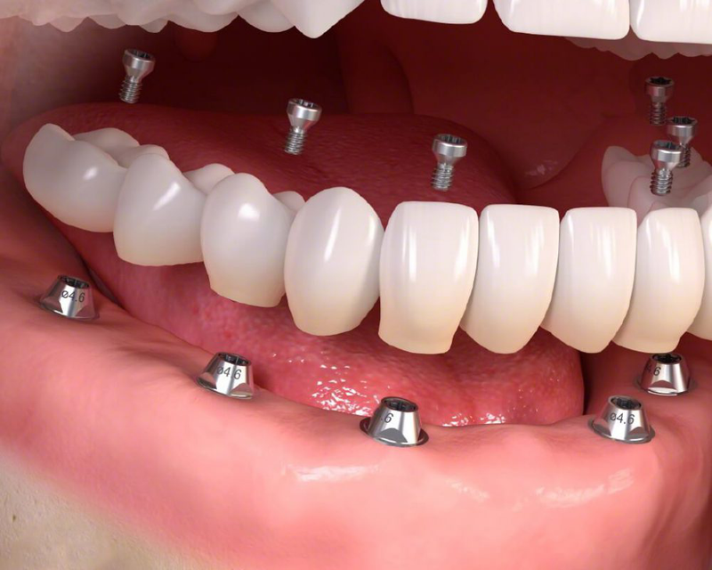 Phục hình răng là gì? Có những phương pháp phục hình răng nào?-4