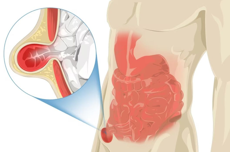 Tìm hiểu về phương pháp Lichtenstein trong điều trị thoát vị bẹn 1