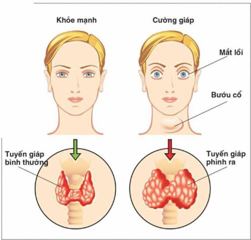 Phương pháp chẩn đoán cường giáp và cách điều trị hiệu quả 1