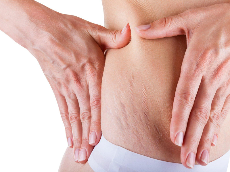 Phương pháp điều trị tình trạng căng da bụng hiệu quả 4