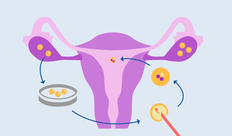 Phương pháp IMSI – Kỹ thuật chọn lọc tinh trùng cho IVF/ICSI 4