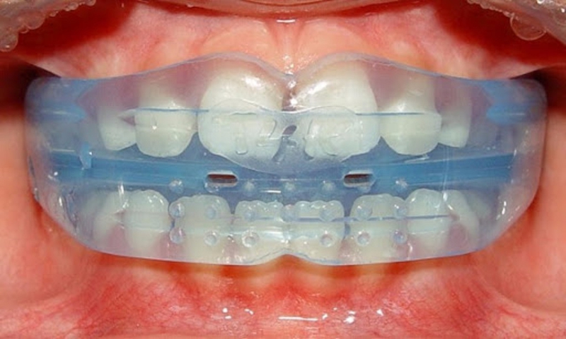 Phương pháp niềng răng tháo lắp là gì? Niềng răng tháo lắp có thật sự hiệu quả không? 1