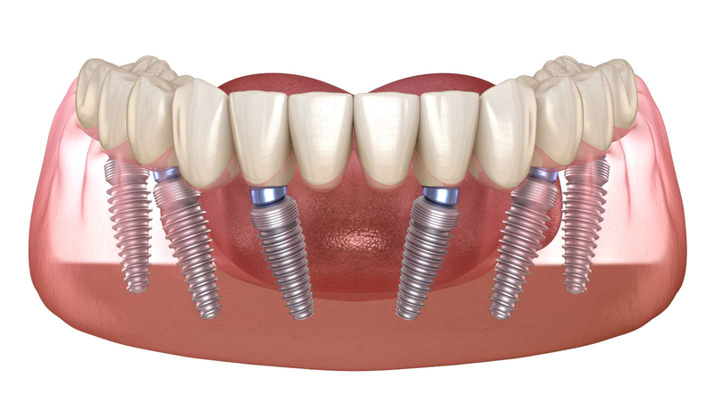 Phương pháp trồng răng Implant all on 6 có ưu điểm gì? 1