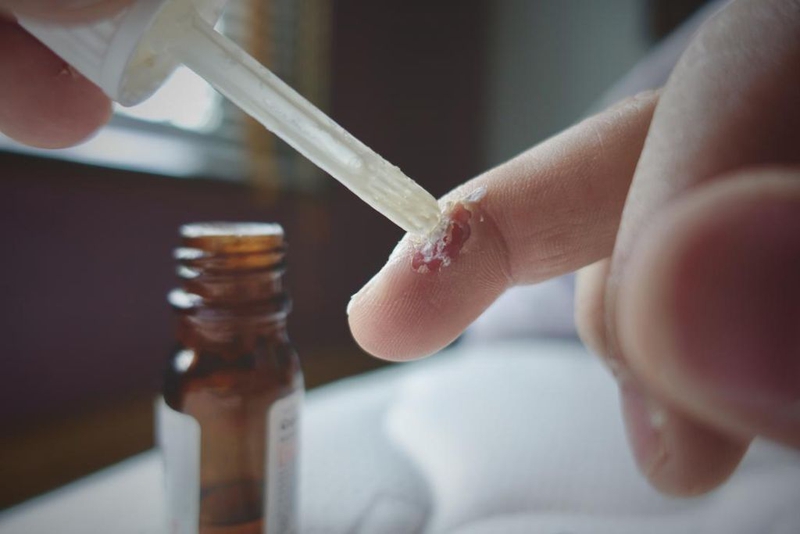 Phương pháp xịt al có hết sùi mào gà không? Các biện pháp điều trị sùi mào gà 3