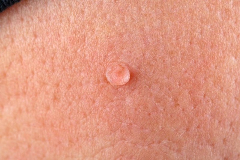 Phương pháp xịt al có hết sùi mào gà không? Các biện pháp điều trị sùi mào gà 4