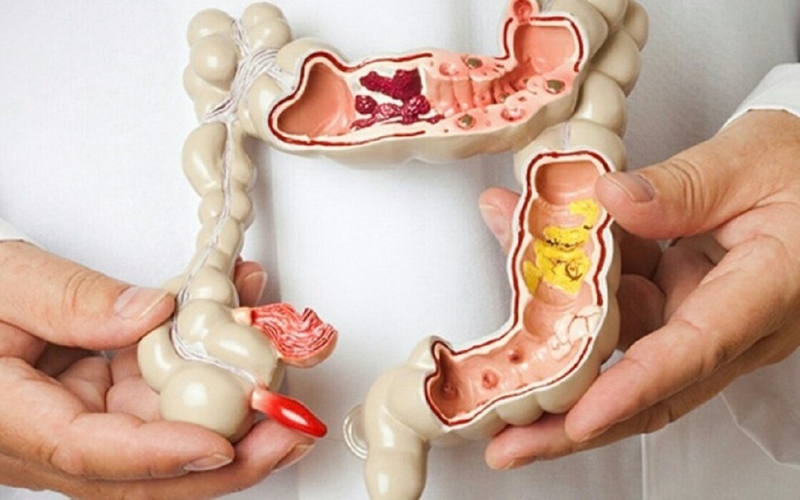 Polyp đại tràng không cuống là gì? 1