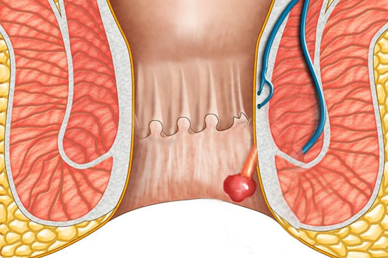 Phân biệt hai bệnh trên để có biện pháp điều trị thích hợp