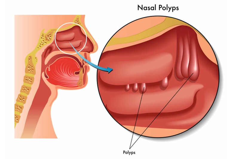 Polyp mũi ở trẻ nhỏ có nguy hiểm đến tính mạng không? 2