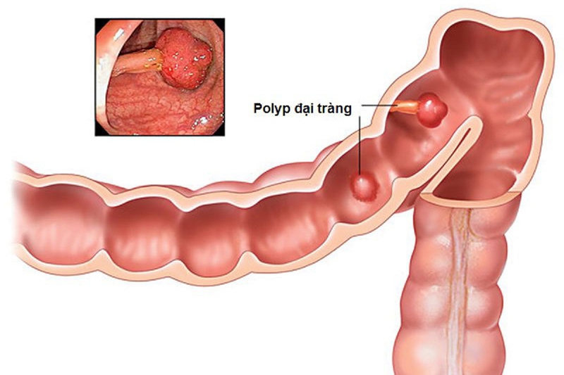 Polyp ống tiêu hóa: Nguyên nhân, điều trị và cách phòng ngừa 4