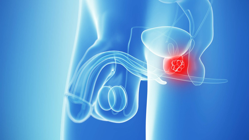 Prostate cancer là gì? Triệu chứng và các giai đoạn của bệnh 1