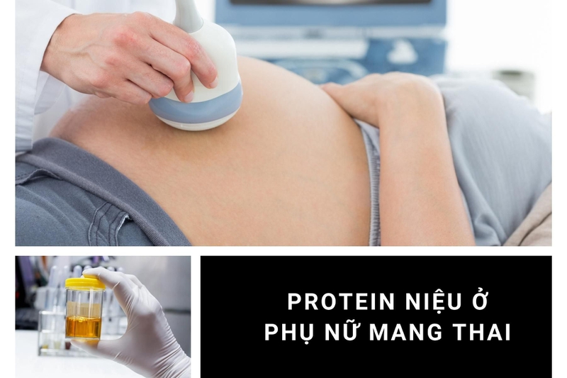 Khi protein niệu khi mang thai tăng cao, đó có thể là dấu hiệu cảnh báo những bất thường