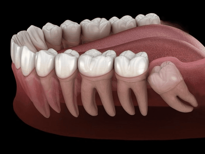 Quá trình mọc răng khôn diễn ra như thế nào? 1