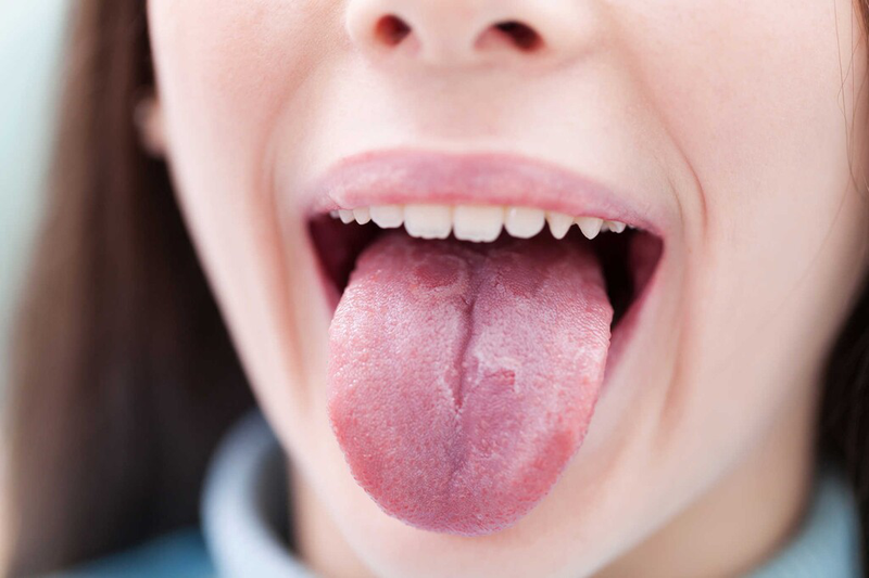 Quan hệ bằng miệng có bị lây sùi mào gà? Những triệu chứng thường gặp khi bị sùi mào gà2