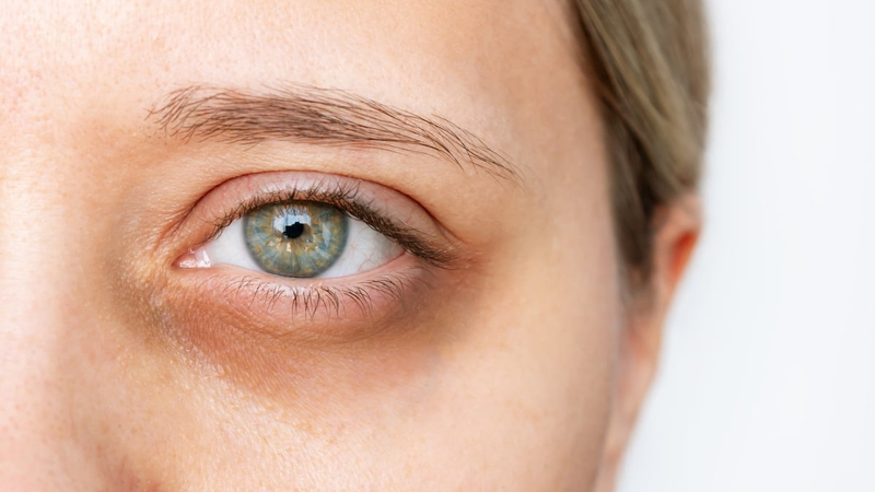Quầng thâm mắt có phải biểu hiện của bệnh không? Cách trị quầng thâm mắt 2