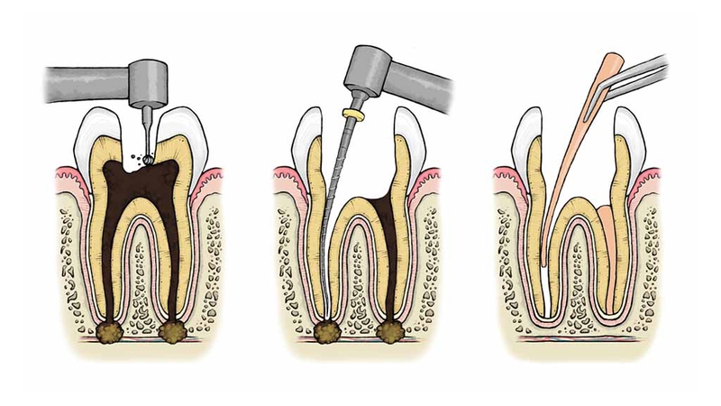 Quy trình diệt tủy răng và cách chăm sóc răng sau khi diệt tủy 2