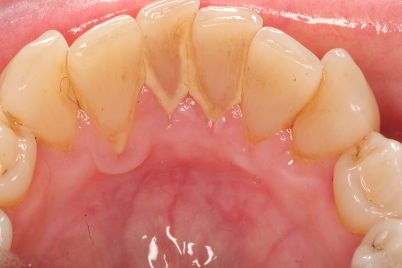 Quy trình lấy cao răng chuẩn được thực hiện như thế nào? 3