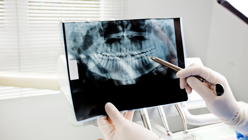Quy trình niềng răng mắc cài kim loại chuẩn y khoa 1