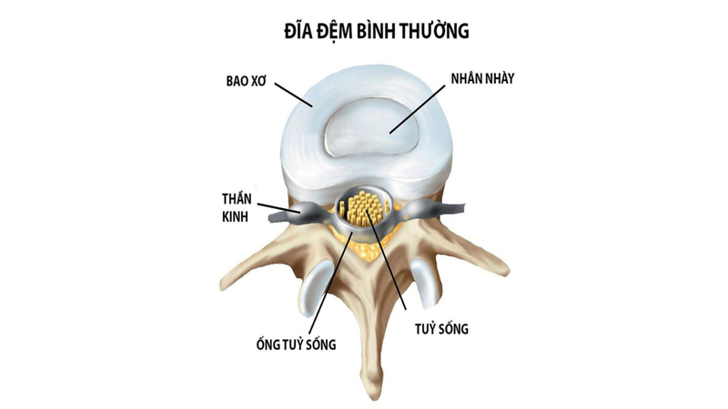 rách bao xơ đĩa đệm 1