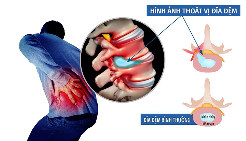 Bị rách vòng xơ đĩa đệm có nguy hiểm không? 3