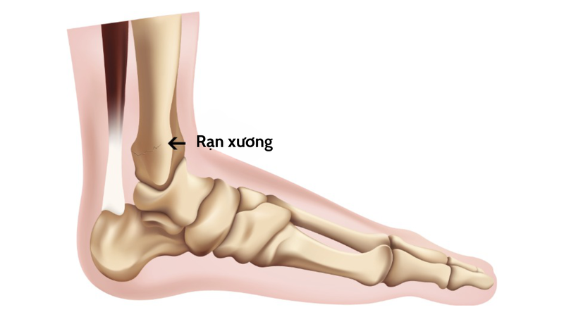 Rạn xương có tự khỏi không 1