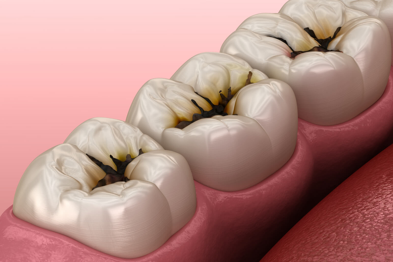 Răng cấm bị hư: Nguyên nhân và cách điều trị 3
