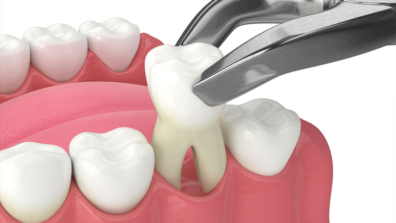 Răng cấm bị hư: Nguyên nhân và cách điều trị 4