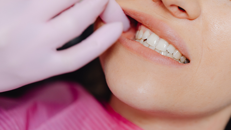 Răng cao răng thấp làm thế nào để khắc phục? 3
