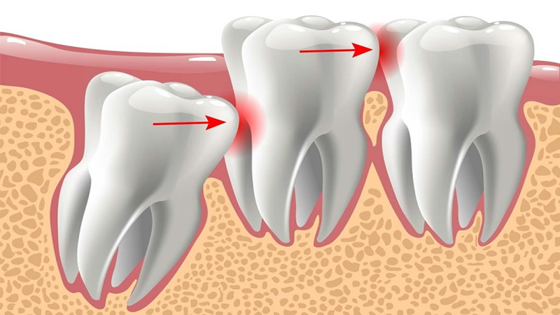 Răng cối lớn là gì? Đặc điểm và vai trò của răng cối lớn 3