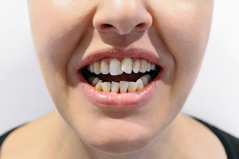 Răng cửa khấp khểnh có nguyên nhân do đâu và cách cải thiện 2