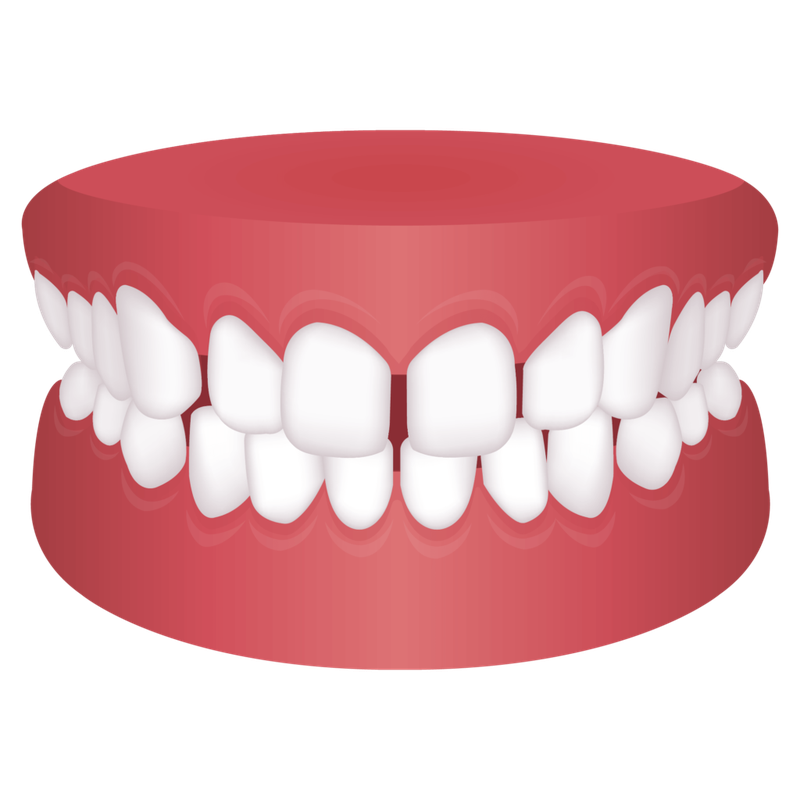 Răng cửa thưa: Nguyên nhân và cách khắc phục 2