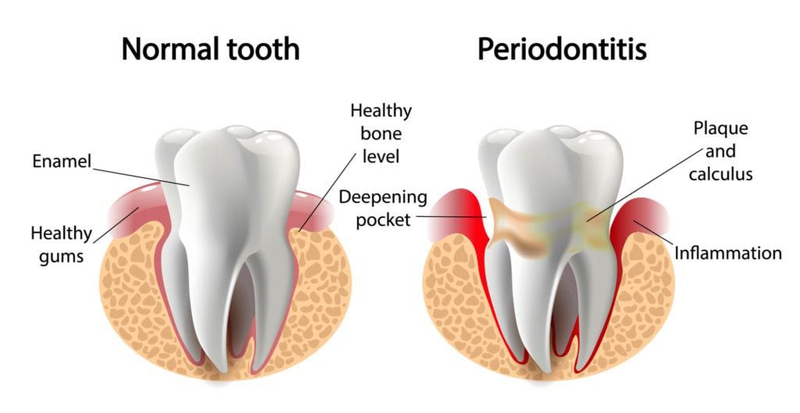 Răng cửa thưa: Nguyên nhân và cách khắc phục 4