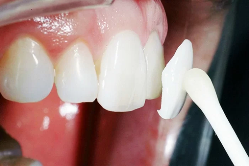 Răng cửa thưa: Nguyên nhân và cách khắc phục 6