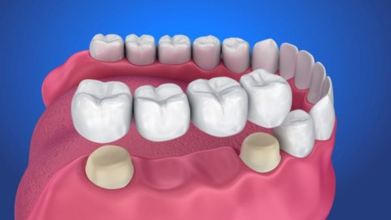 Người bị mất 2 răng liên tiếp sẽ là lựa chọn lý tưởng