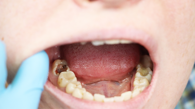 Răng hàm bị vỡ có nguy hiểm không? 1