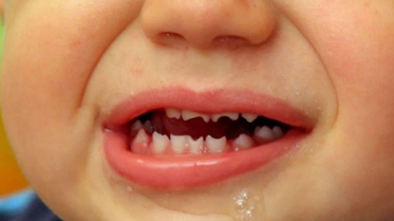 Răng hutchinson và những điều cần biết về bệnh 1