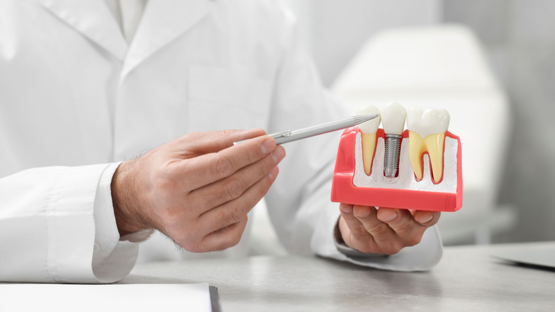 Răng Implant bị lung lay do đâu? Cách khắc phục hiệu quả 1