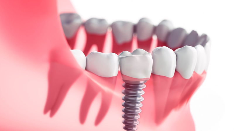 Răng Implant bị lung lay do đâu? Cách khắc phục hiệu quả 2