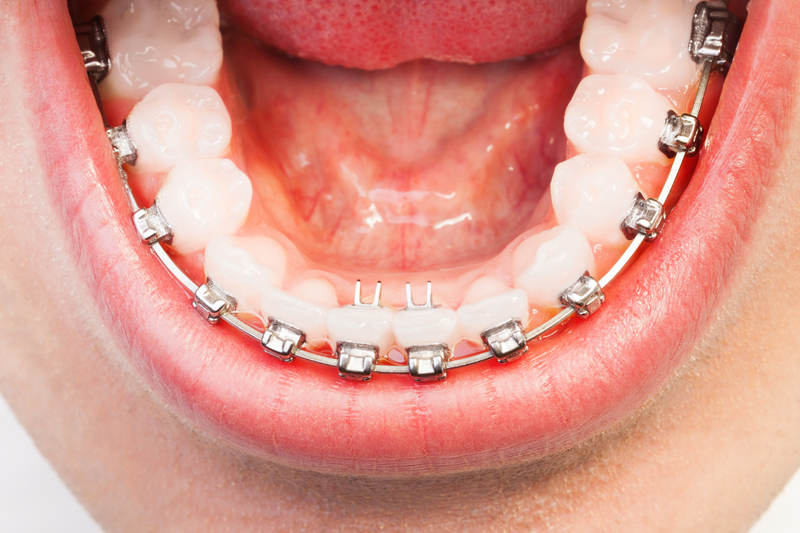 Răng khểnh hàm dưới có đặc điểm gì? 2 cách cải thiện phổ biến hiện nay 3