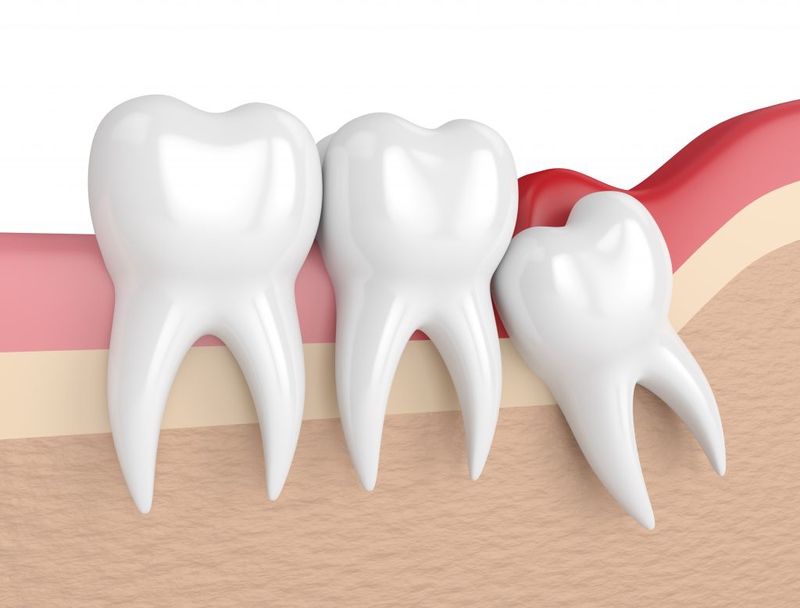 Răng khôn là gì? Vị trí răng khôn mọc ở đâu? 3