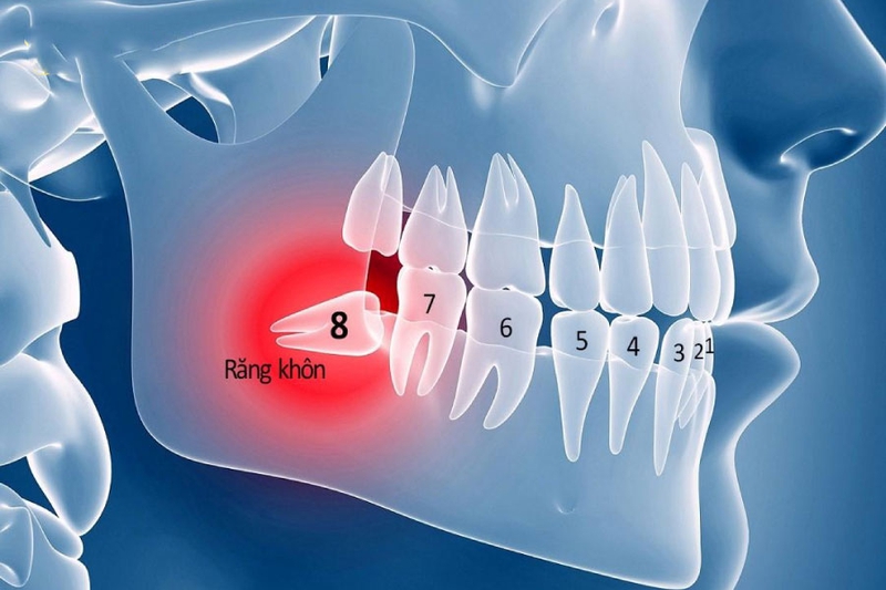 Răng khôn là gì? Vị trí răng khôn mọc ở đâu? 1