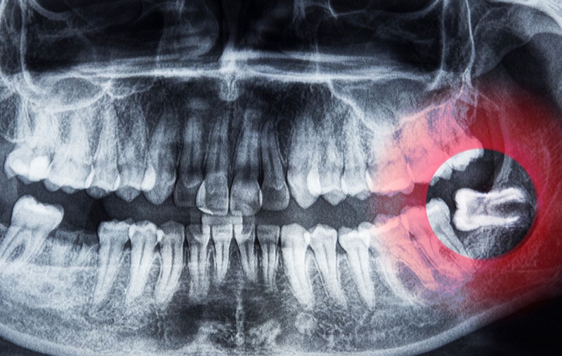 Răng khôn là răng số mấy? Các vấn đề liên quan đến răng khôn 2