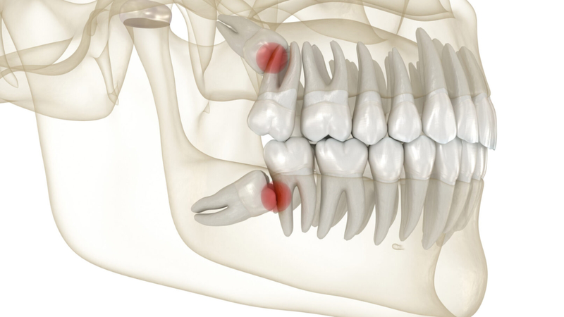 Răng khôn mọc lệch: Dấu hiệu, nguyên nhân và cách xử lý an toàn 3