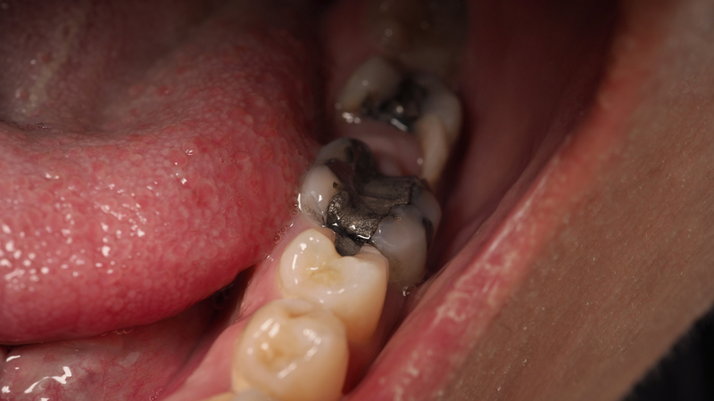 Răng khôn mọc lệch ra má: Nguyên nhân, có nguy hiểm không? 2