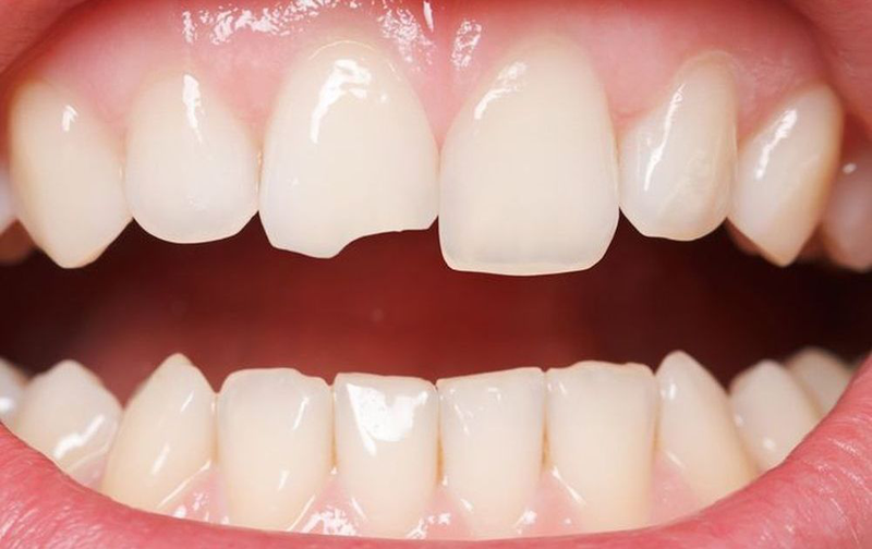Răng mẻ thiếu chất gì? Các phương pháp điều trị răng mẻ hiệu quả 1