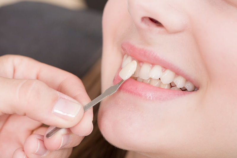 Răng mẻ thiếu chất gì? Các phương pháp điều trị răng mẻ hiệu quả 3