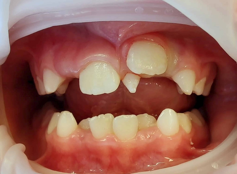 Tìm hiểu chi tiết về tình trạng răng mọc ngược 1