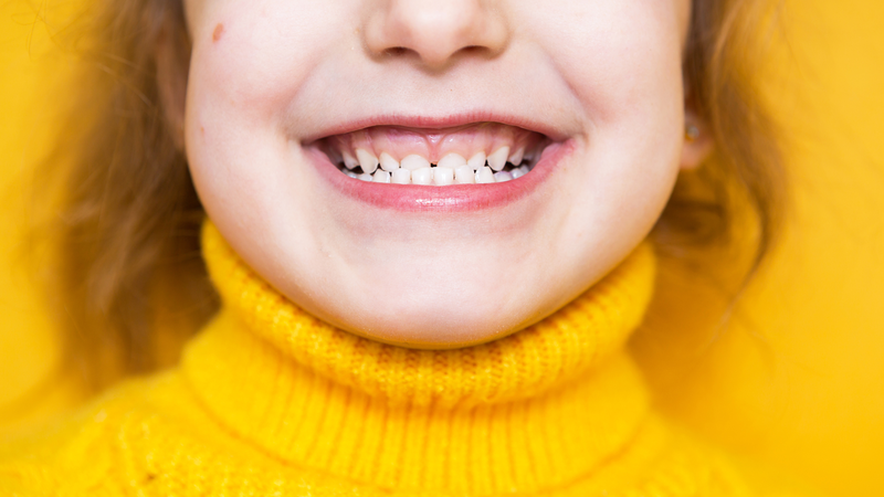 Răng móm là tình trạng hàm dưới đưa ra trước so với hàm trên