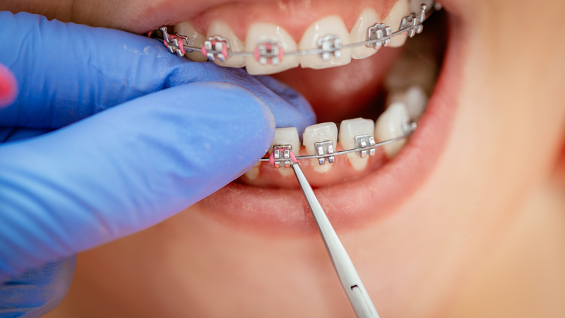 Niềng răng có thể hết móm, nhưng chỉ trong trường hợp móm do răng