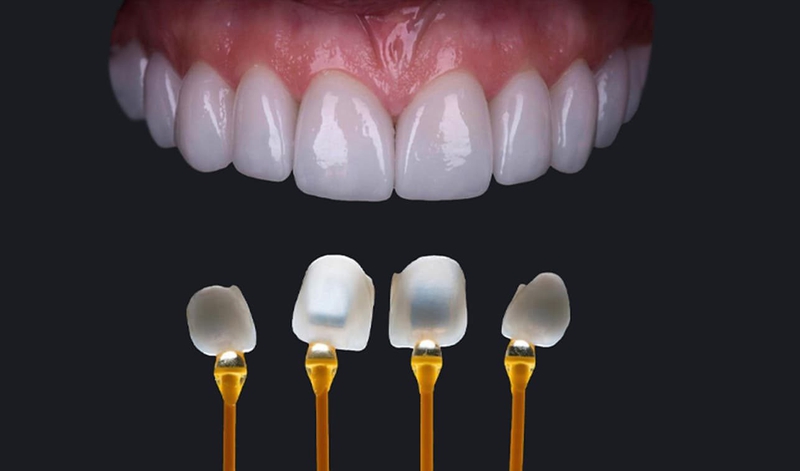 Răng ngắn nên làm gì? Nguyên nhân và cách khắc phục răng ngắn 4
