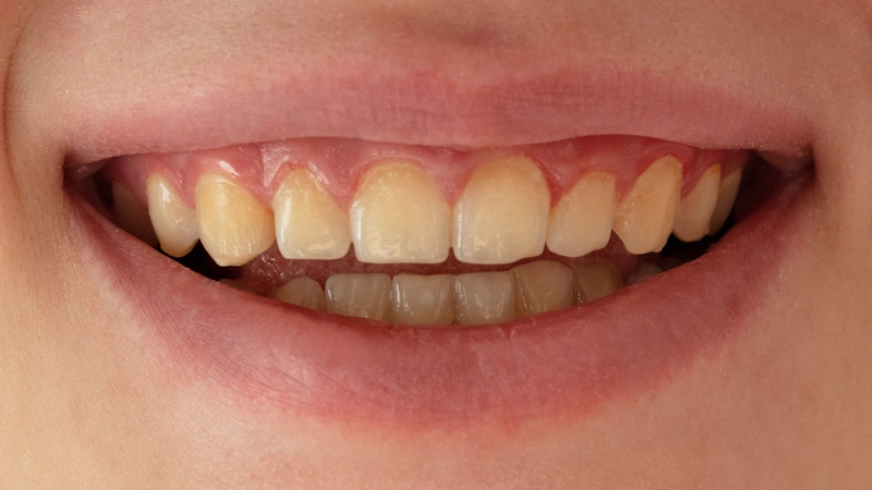 Răng ngắn phải làm sao? Làm thế nào để khắc phục? 1